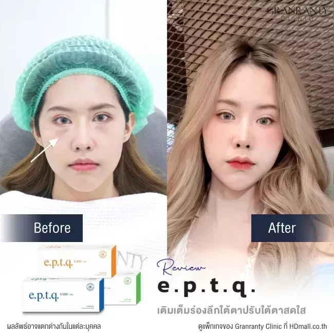 รีวิว ฉีดฟิลเลอร์ใต้ตา ที่ Granranty Clinic รูปที่ 4