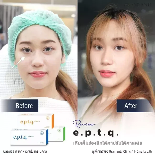 รีวิว ฉีดฟิลเลอร์ใต้ตา ที่ Granranty Clinic รูปที่ 5