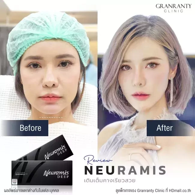 รีวิว ฉีดฟิลเลอร์คาง ที่ Granranty Clinic รูปที่ 1