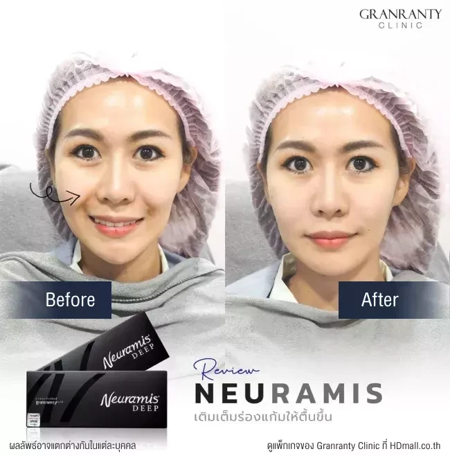 รีวิว ฉีดฟิลเลอร์ร่องแก้ม ที่ Granranty Clinic รูปที่ 1