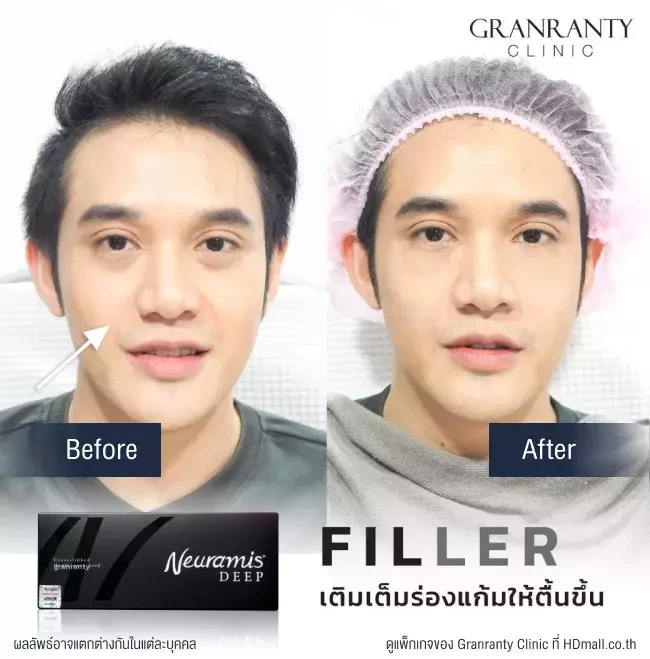 รีวิว ฉีดฟิลเลอร์ร่องแก้ม ที่ Granranty Clinic รูปที่ 2