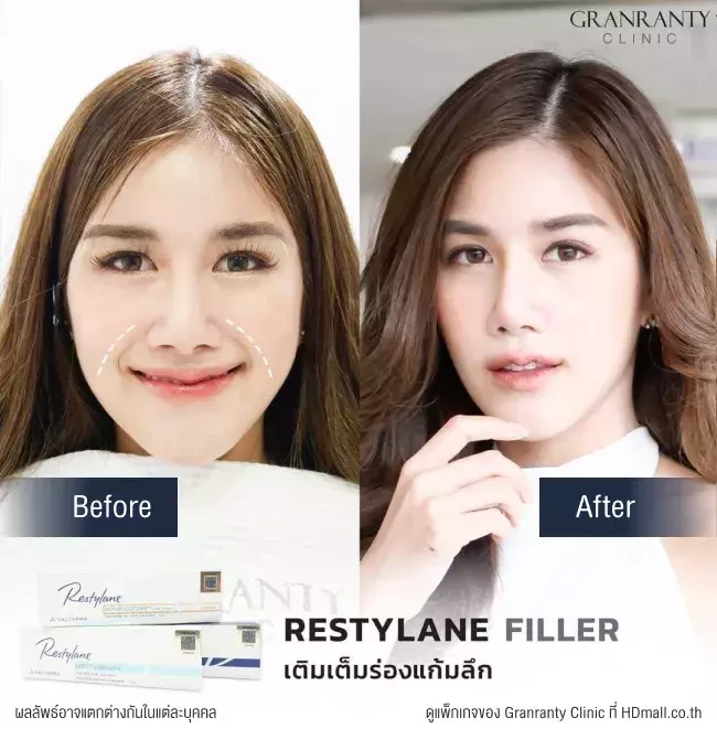 รีวิว ฉีดฟิลเลอร์ร่องแก้ม ที่ Granranty Clinic รูปที่ 3