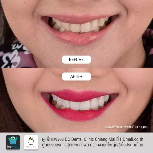 รีวิว ทำวีเนียร์ ที่ DC Dental Clinic Chiang Mai รูปที่ 3