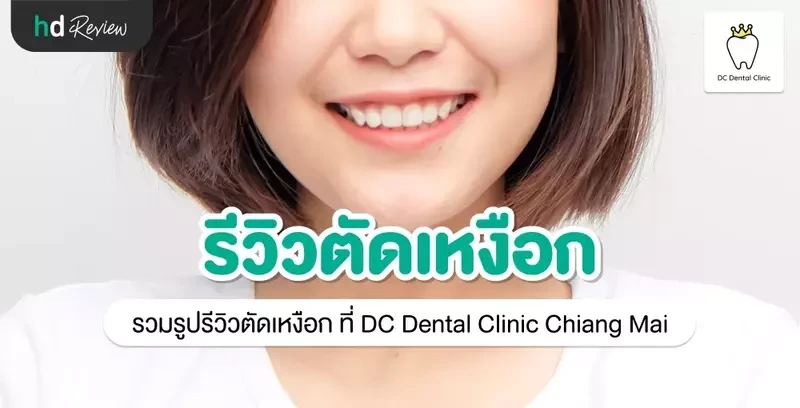 รีวิว ตัดเหงือก ที่ DC Dental Clinic Chiang Mai