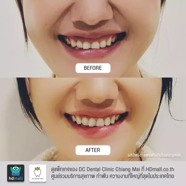รีวิว ตัดเหงือก ที่ DC Dental Clinic Chiang Mai รูปที่ 1