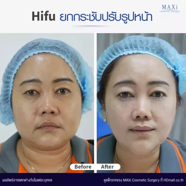 รีวิวทำ HIFU ที่ MAXi Cosmetic Surgery รูปที่ 1