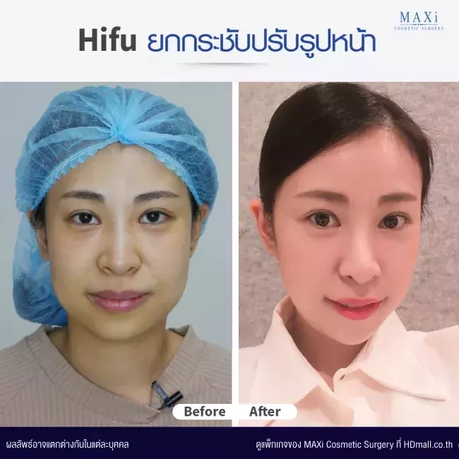 รีวิวทำ HIFU ที่ MAXi Cosmetic Surgery รูปที่ 2