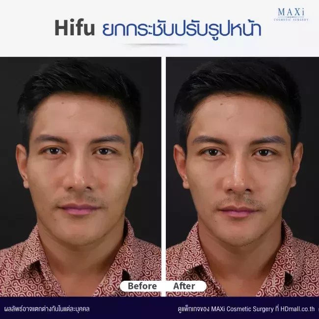 รีวิวทำ HIFU ที่ MAXi Cosmetic Surgery รูปที่ 3