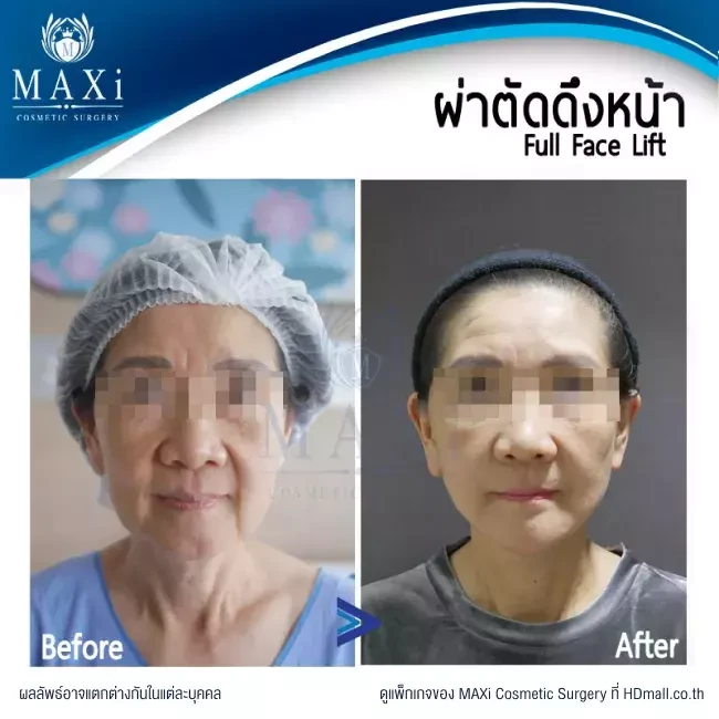 รีวิวศัลยกรรมดึงหน้า ที่ MAXi Cosmetic Surgery รูปที่ 10