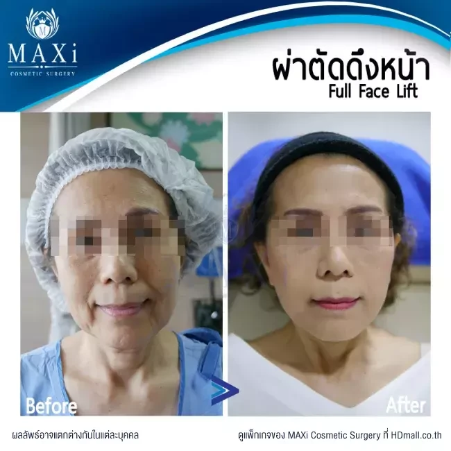 รีวิวศัลยกรรมดึงหน้า ที่ MAXi Cosmetic Surgery รูปที่ 11