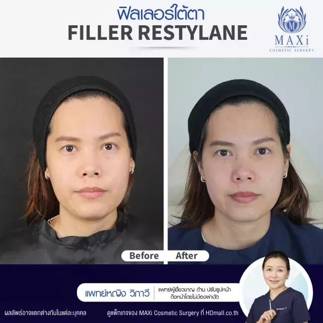 รีวิว ฉีดฟิลเลอร์ใต้ตา ที่ MAXi Cosmetic Surgery รูปที่ 2