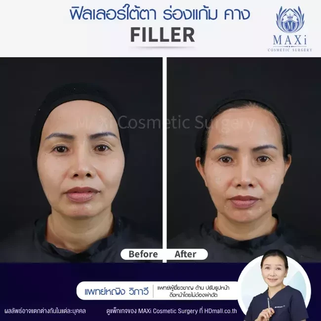 รีวิว ฉีดฟิลเลอร์ใต้ตา ที่ MAXi Cosmetic Surgery รูปที่ 4