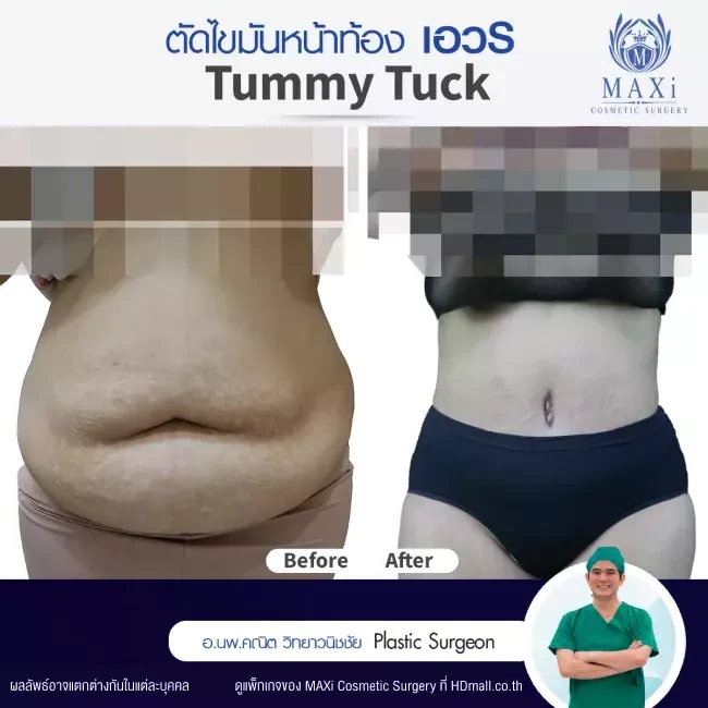 รีวิว ตัดไขมันหน้าท้อง ที่ MAXi Cosmetic Surgery รูปที่ 1