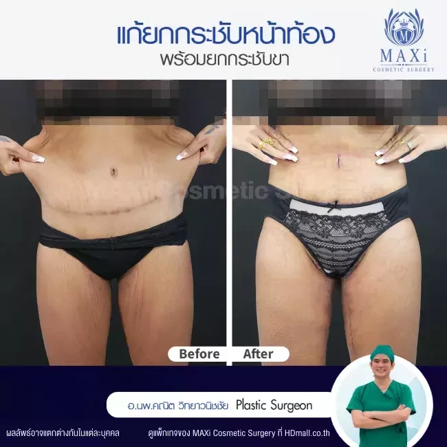 รีวิว ตัดไขมันหน้าท้อง ที่ MAXi Cosmetic Surgery รูปที่ 2