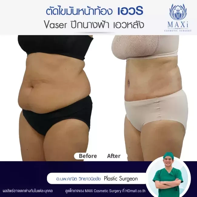 รีวิว ตัดไขมันหน้าท้อง ที่ MAXi Cosmetic Surgery รูปที่ 3