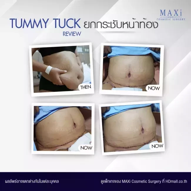 รีวิว ตัดไขมันหน้าท้อง ที่ MAXi Cosmetic Surgery รูปที่ 8