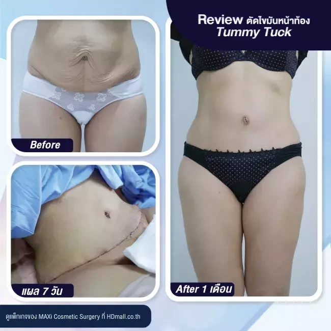 รีวิว ตัดไขมันหน้าท้อง ที่ MAXi Cosmetic Surgery รูปที่ 16