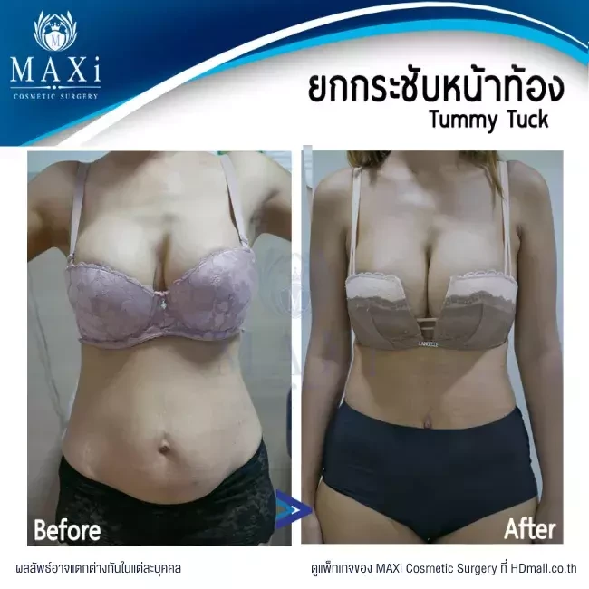 รีวิว ตัดไขมันหน้าท้อง ที่ MAXi Cosmetic Surgery รูปที่ 17