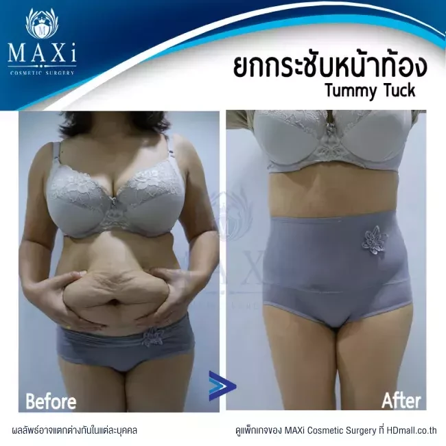 รีวิว ตัดไขมันหน้าท้อง ที่ MAXi Cosmetic Surgery รูปที่ 18