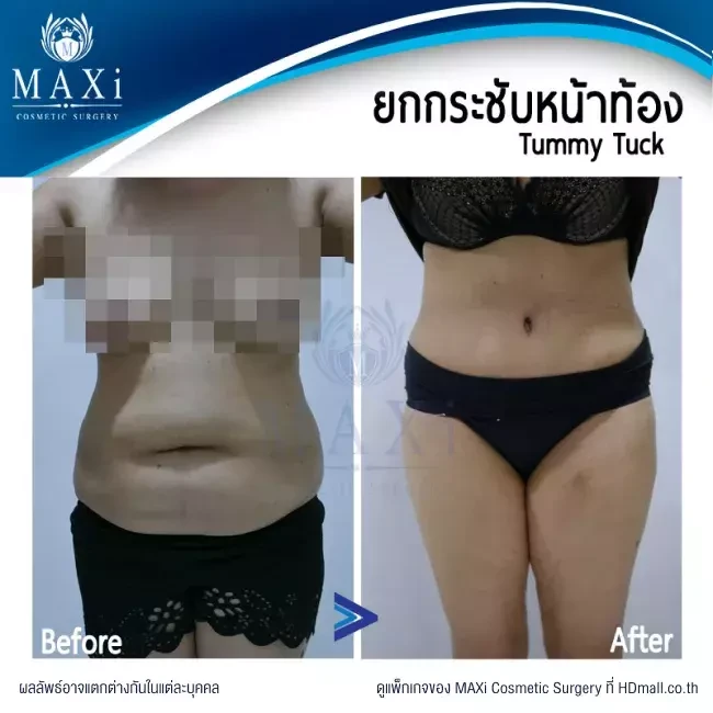 รีวิว ตัดไขมันหน้าท้อง ที่ MAXi Cosmetic Surgery รูปที่ 19