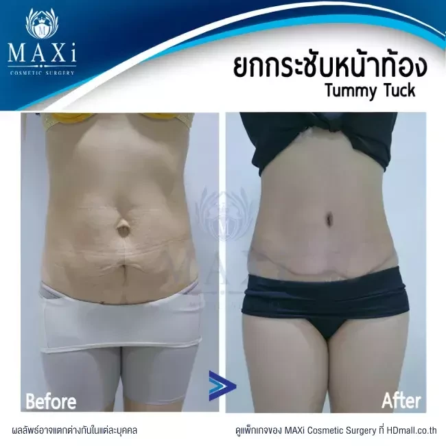 รีวิว ตัดไขมันหน้าท้อง ที่ MAXi Cosmetic Surgery รูปที่ 20