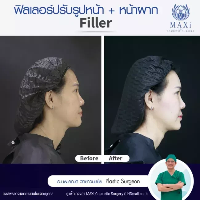 รีวิว ฉีดฟิลเลอร์ปรับรูปหน้า ที่ MAXi Cosmetic Surgery รูปที่ 1