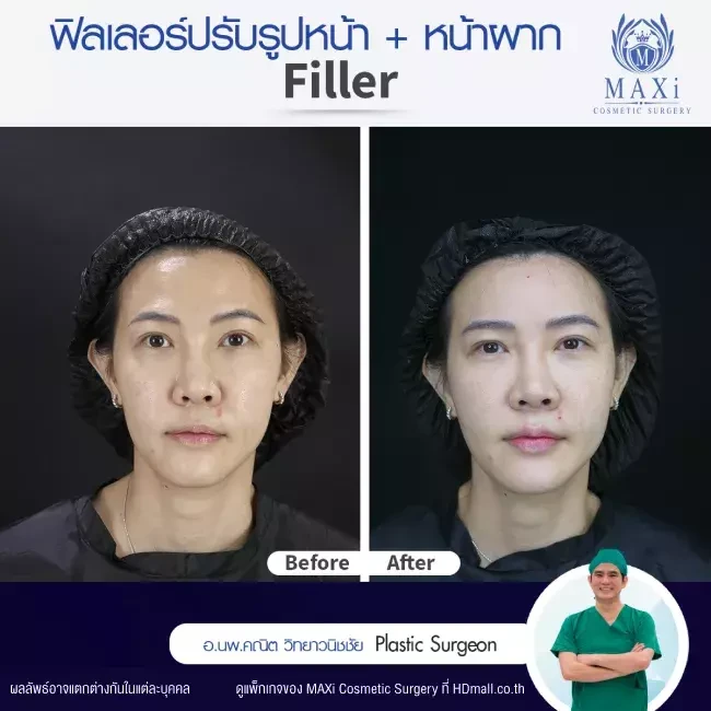 รีวิว ฉีดฟิลเลอร์ปรับรูปหน้า ที่ MAXi Cosmetic Surgery รูปที่ 2