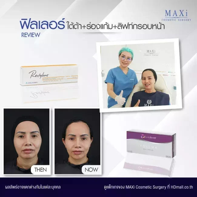 รีวิว ฉีดฟิลเลอร์ปรับรูปหน้า ที่ MAXi Cosmetic Surgery รูปที่ 3