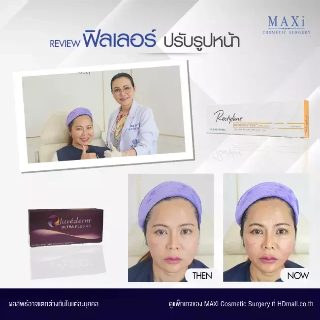 รีวิว ฉีดฟิลเลอร์ปรับรูปหน้า ที่ MAXi Cosmetic Surgery รูปที่ 4