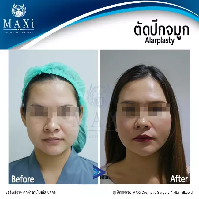 รีวิว ตัดปีกจมูก ที่ MAXi Cosmetic Surgery รูปที่ 1