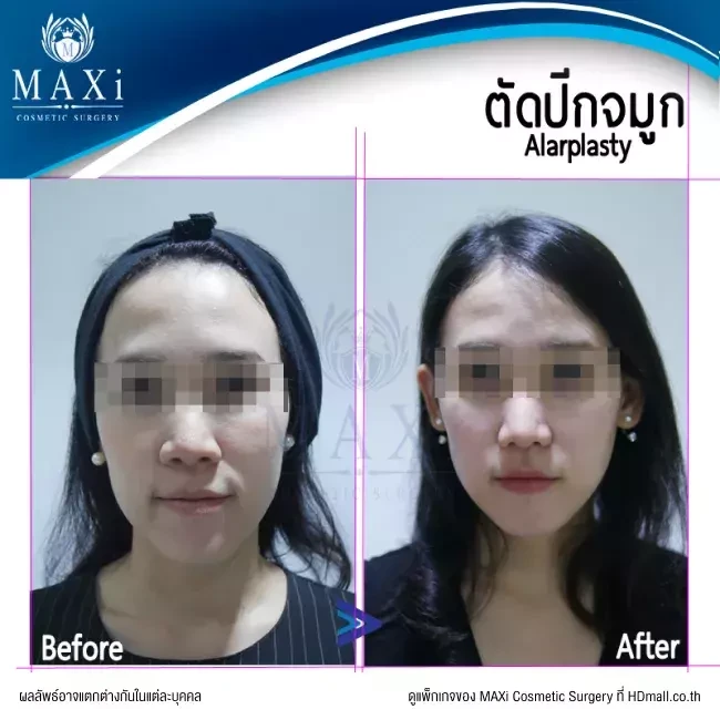 รีวิว ตัดปีกจมูก ที่ MAXi Cosmetic Surgery รูปที่ 3