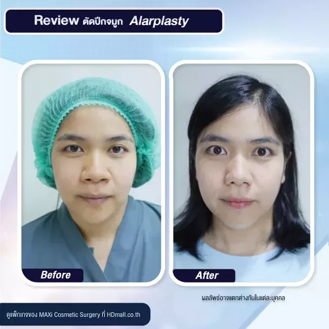 รีวิว ตัดปีกจมูก ที่ MAXi Cosmetic Surgery รูปที่ 12