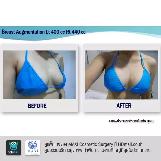 รีวิว เสริมหน้าอก ที่ MAXi Cosmetic Surgery รูปที่ 7