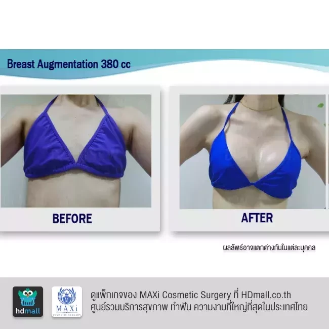 รีวิว เสริมหน้าอก ที่ MAXi Cosmetic Surgery รูปที่ 8