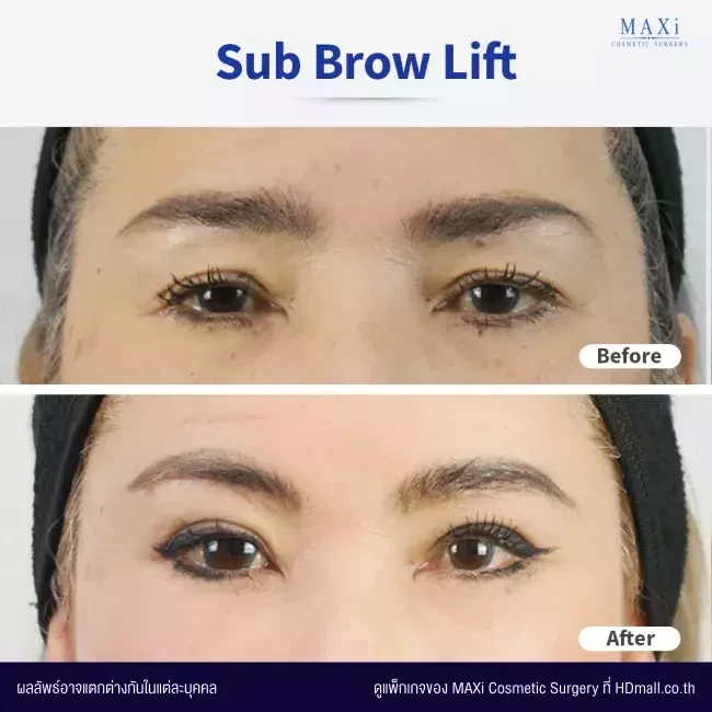 รีวิว Sub Brow Lift แก้ปัญหาหนังตาตก ที่ MAXi Cosmetic Surgery รูปที่ 1