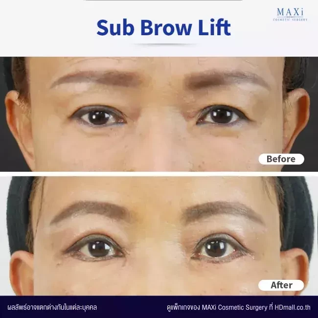 รีวิว Sub Brow Lift แก้ปัญหาหนังตาตก ที่ MAXi Cosmetic Surgery รูปที่ 2