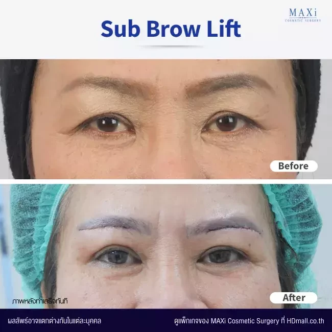 รีวิว Sub Brow Lift แก้ปัญหาหนังตาตก ที่ MAXi Cosmetic Surgery รูปที่ 3