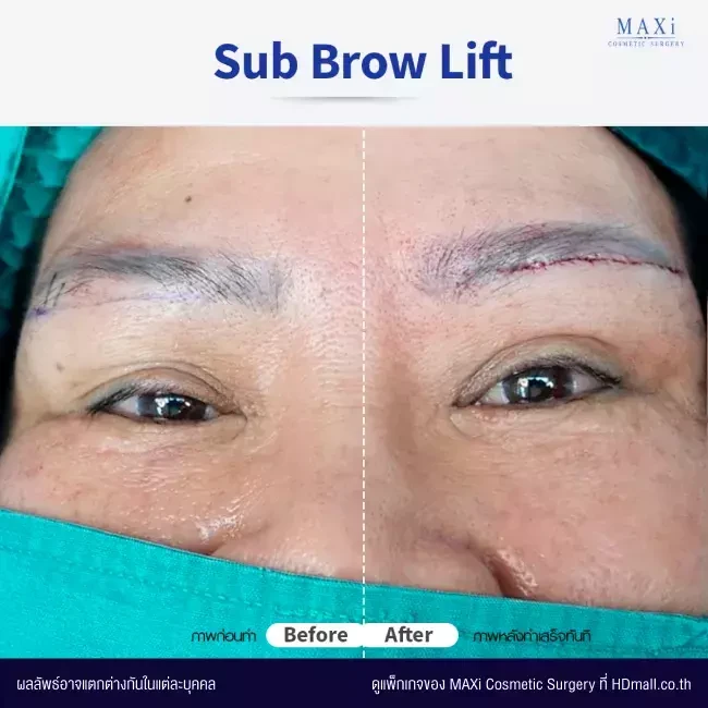 รีวิว Sub Brow Lift แก้ปัญหาหนังตาตก ที่ MAXi Cosmetic Surgery รูปที่ 4