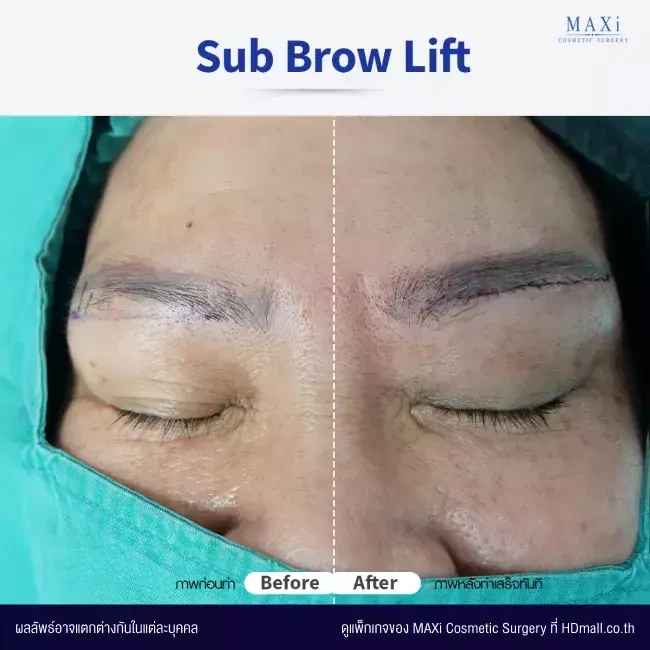 รีวิว Sub Brow Lift แก้ปัญหาหนังตาตก ที่ MAXi Cosmetic Surgery รูปที่ 5