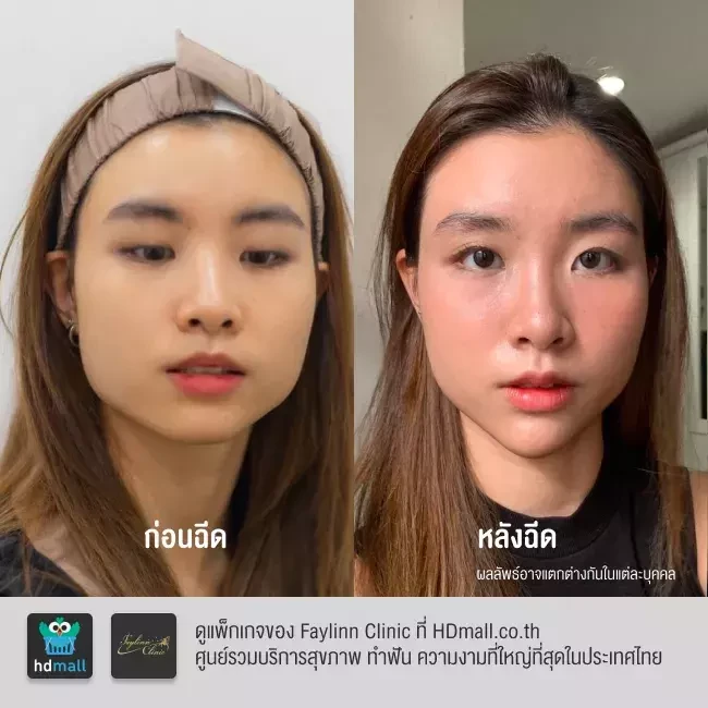 รีวิว ฉีดโบท็อกซ์ ที่ Faylinn Clinic รูปที่ 1