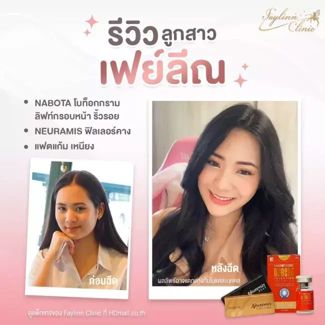 รีวิว ฉีดโบท็อกซ์ ที่ Faylinn Clinic รูปที่ 2