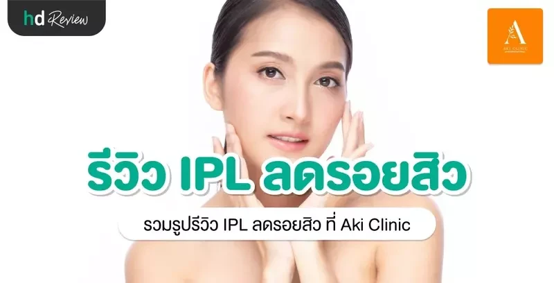 รีวิว IPL ลดรอยสิว ที่ Aki Clinic