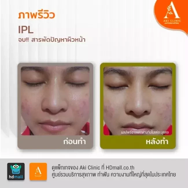 รีวิว IPL ลดรอยสิว ที่ Aki Clinic รูป 1