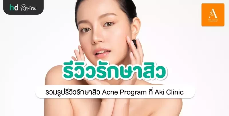 รีวิว รักษาสิว Acne Program ที่ Aki Clinic