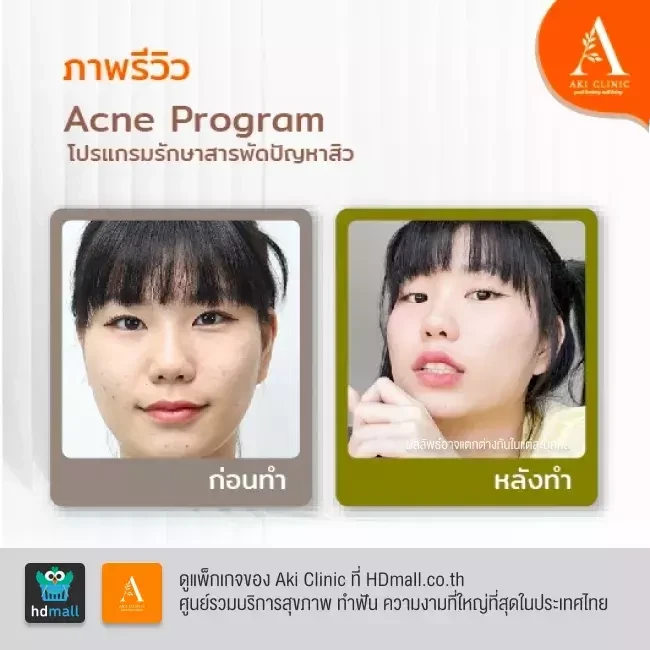 รีวิว รักษาสิว Acne Program ที่ Aki Clinic รูป 2