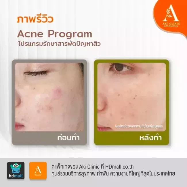 รีวิว รักษาสิว Acne Program ที่ Aki Clinic รูป 3