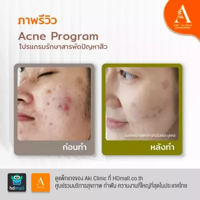 รีวิว รักษาสิว Acne Program ที่ Aki Clinic รูป 4