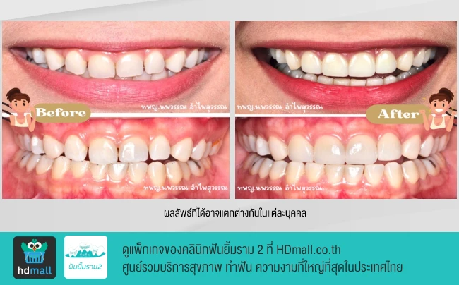 รีวิวทำวีเนียร์ ที่ คลินิกฟันยิ้มรามสอง รูปที่ 1