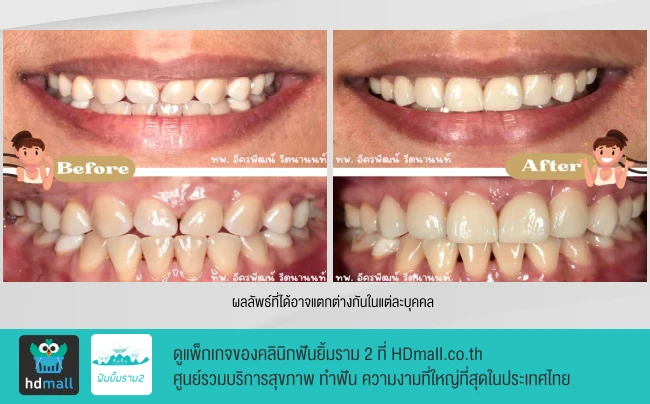 รีวิวทำวีเนียร์ ที่ คลินิกฟันยิ้มรามสอง รูปที่ 2