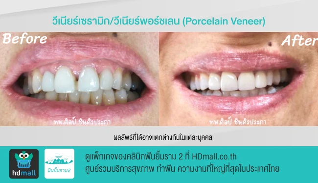 รีวิวทำวีเนียร์ ที่ คลินิกฟันยิ้มรามสอง รูปที่ 3